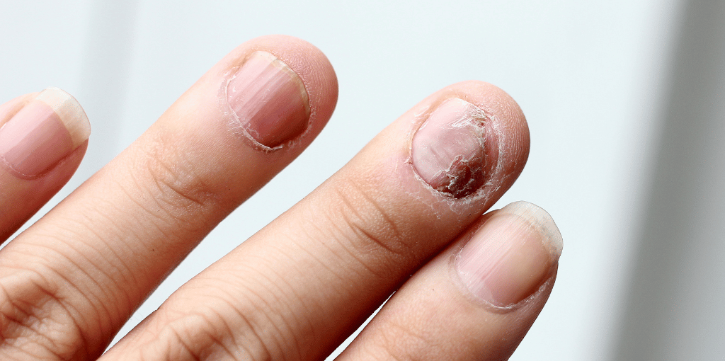 Nail fungal infection