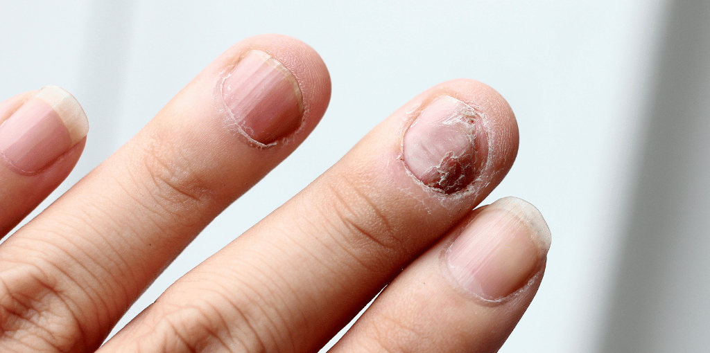 Fungal Nail Infections: Causes, Treatment, and Prevention